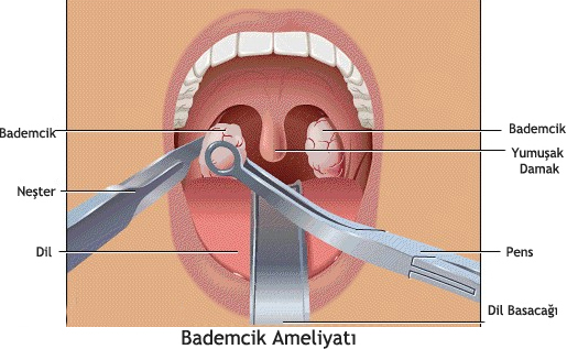 BADEMCİK AMELİYATI: NE ZAMAN? NASIL?